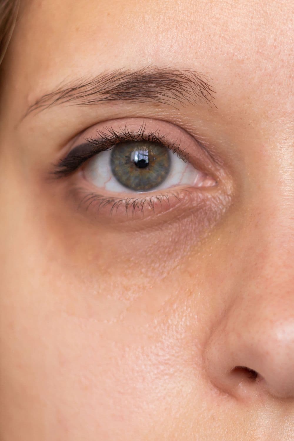 Dark Circles & Puffiness